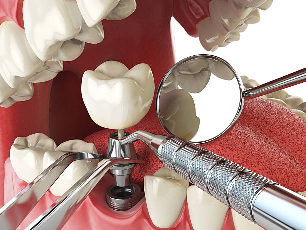 Best Emergency Tooth Extraction in Springfield, MA